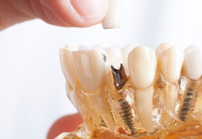 Dental Implants