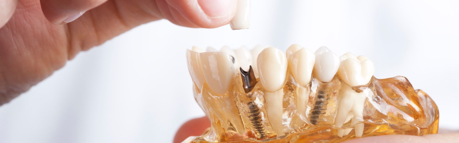 Dental Implants