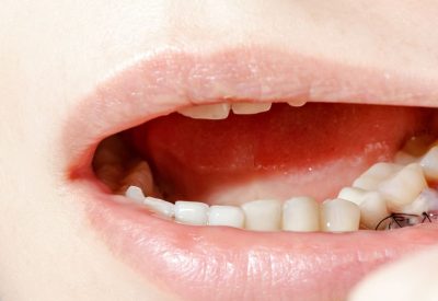 Gum Grafting Surgery